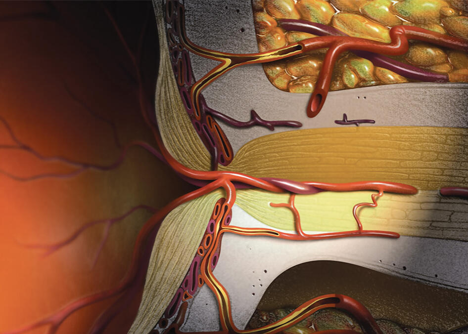 Subject: Optic Neuritis Category: Editorial Illustration Inception: 1998 Intended use: Medical Journal Publication