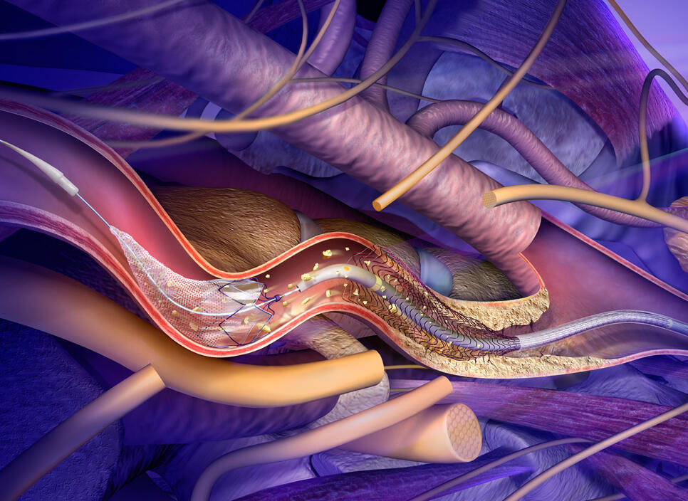 Subject: Embolic Filter Category: Product Illustration Inception: 2008 Intended Use: Medical Device Sales and Marketing